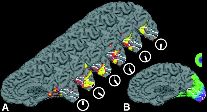 Migraine_Visual_Aura